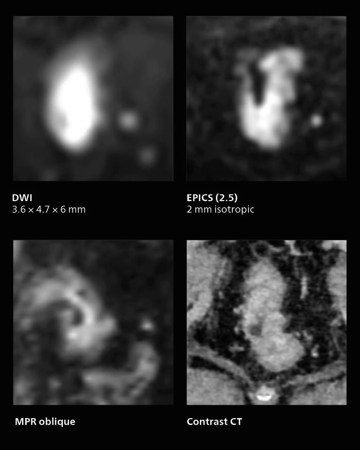 MRI of rectal cancer: fast isotropic 3D acquisitions providing excellent image quality with use of AI-enabled SmartSpeed, mobile two