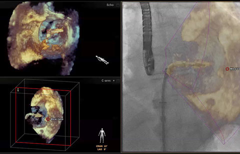 Mitraclip Echonavigator image