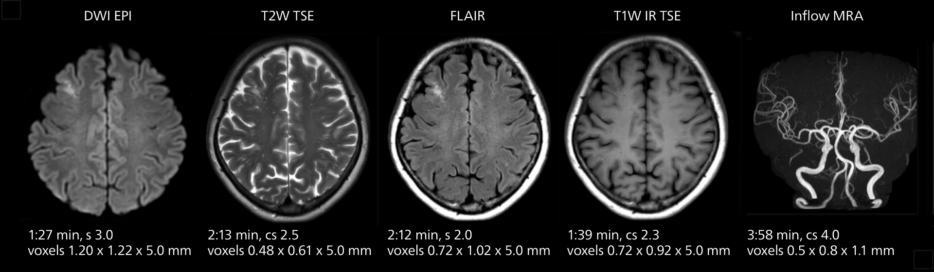 Brain mri