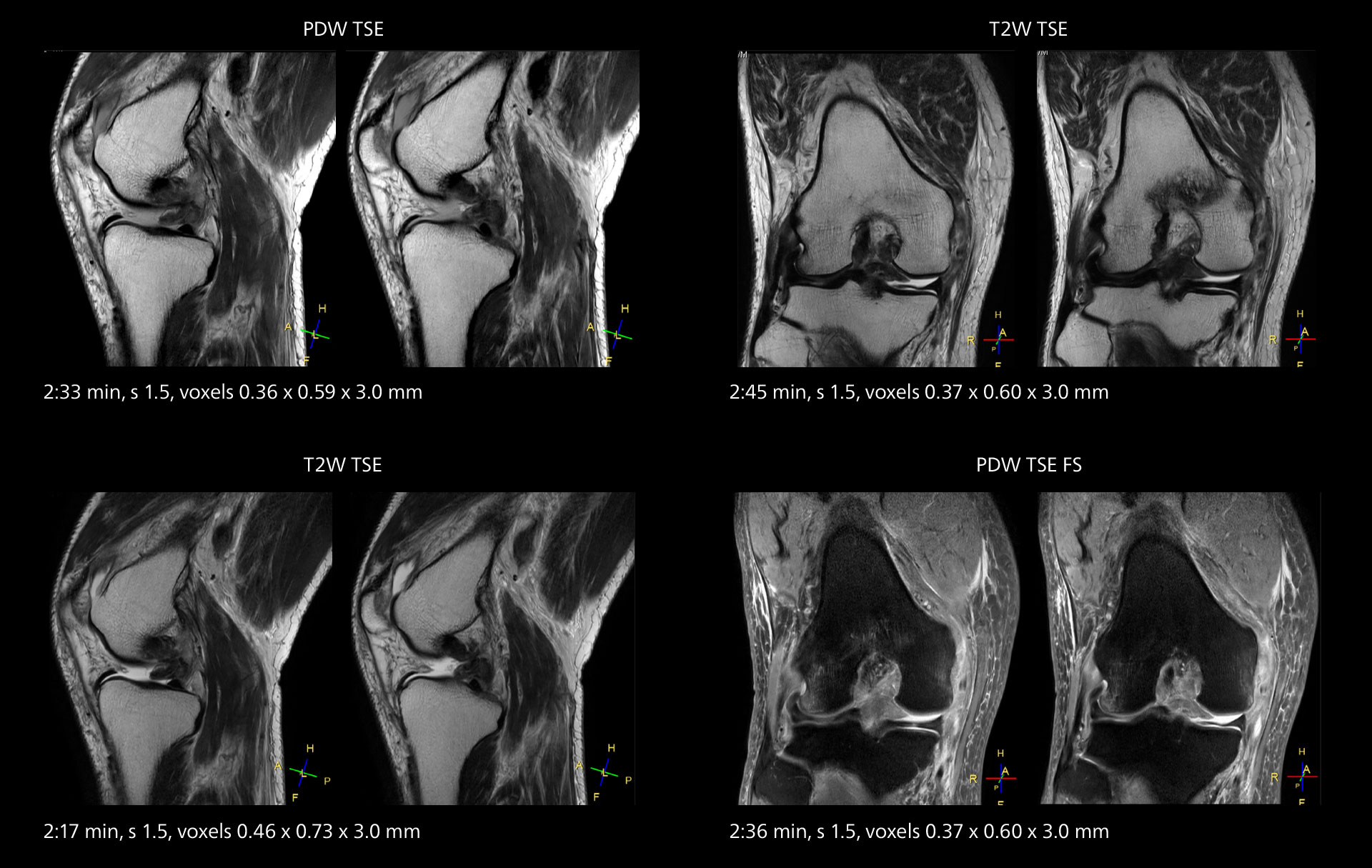 Knee mri