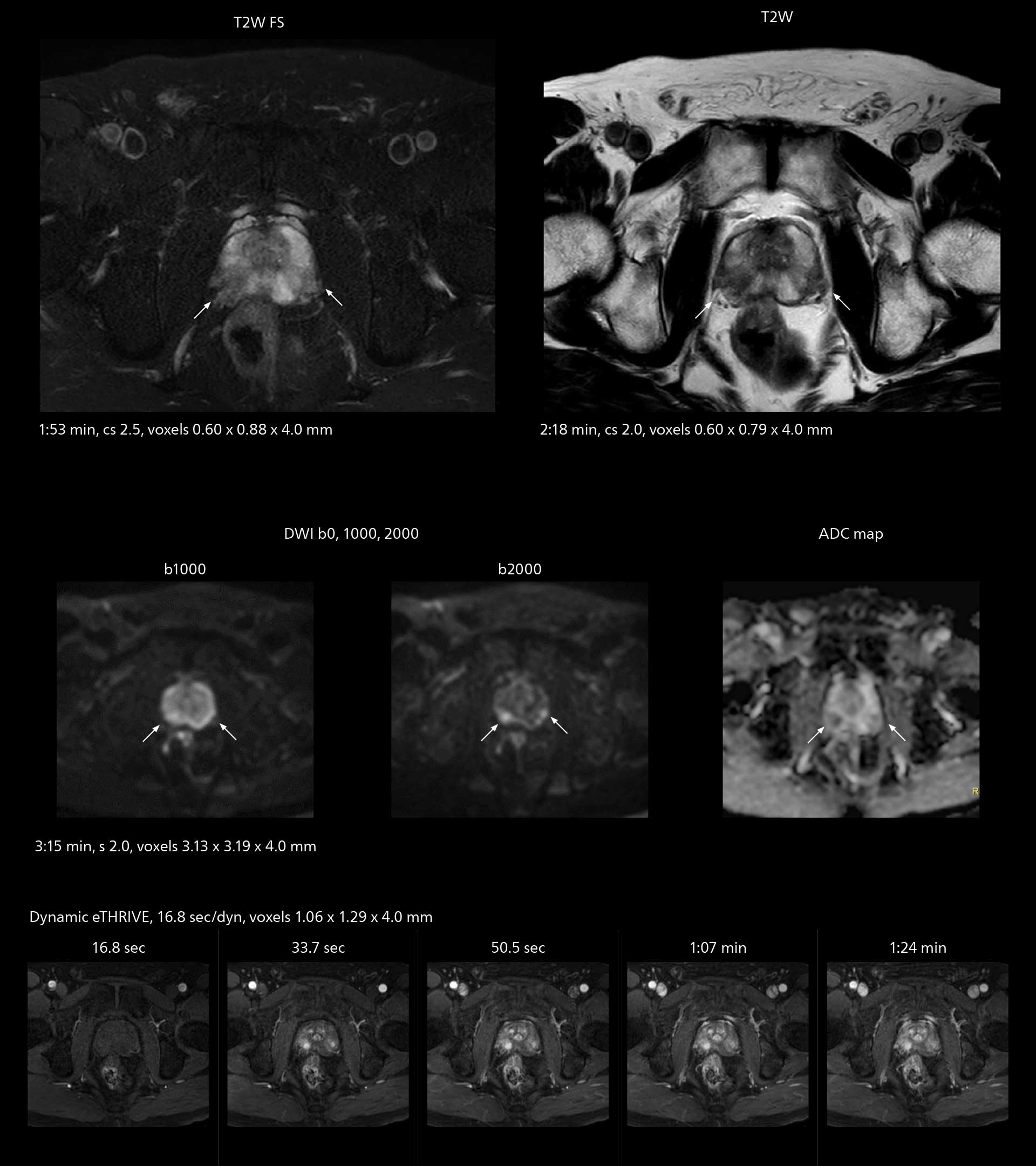 Prostate mri